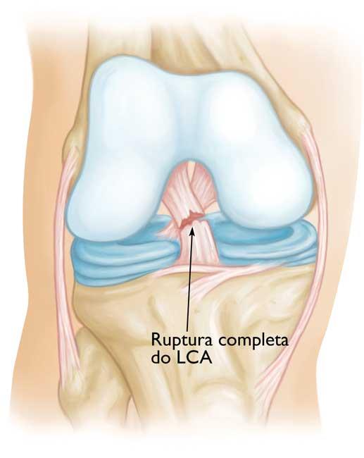 Lesão do ligamento LCA